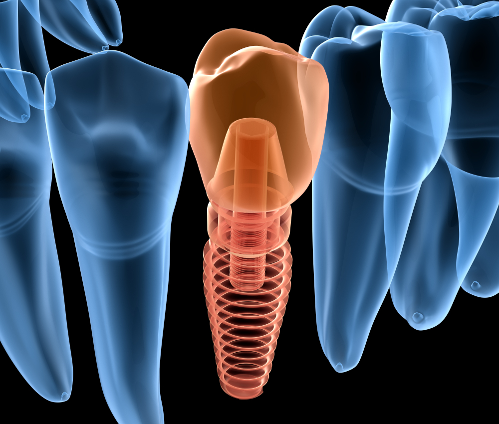 Replacing missing teeth with dental implants