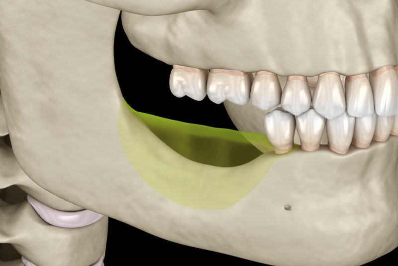 a persons skeletal side profile showing where they need a bone grafting procedure in their lower jawbone.