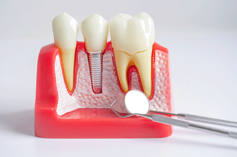 Dental implant, artificial tooth roots into jaw, root canal of dental treatment, gum disease, teeth model for dentist studying about dentistry.